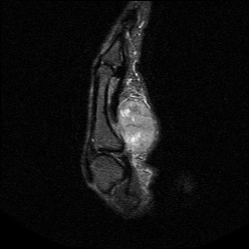 Sarcoma Finger